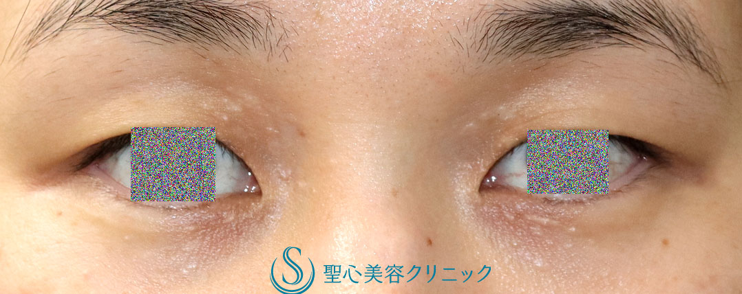 【30代女性・目の周りの汗管腫を治療したい】汗管腫・アグネス治療（聖心美容クリニック 大阪院・横浜院・大宮院 限定処置）（2回処置3か月後） After 