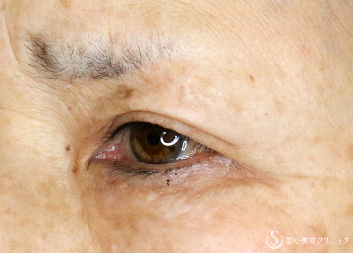 【60代女性・整形ではなく10年前の目元に戻す】眉下リフト単独（2年4ヶ月後） After 