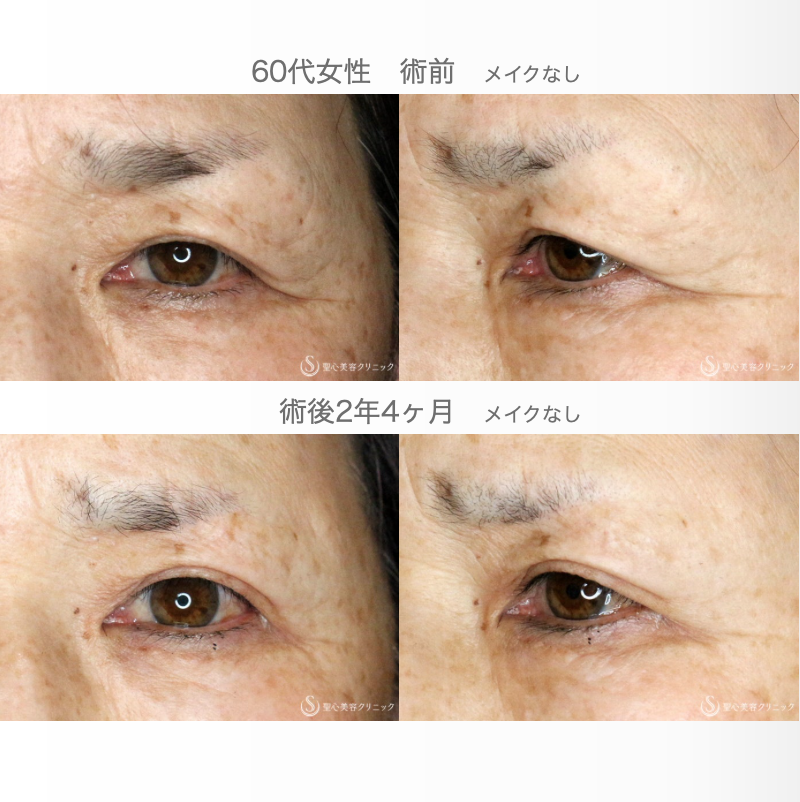 【60代女性・整形ではなく10年前の目元に戻す】眉下リフト単独（2年4ヶ月後） After 