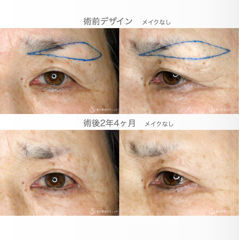 【60代女性・整形ではなく10年前の目元に戻す】眉下リフト単独（2年4ヶ月後） After 