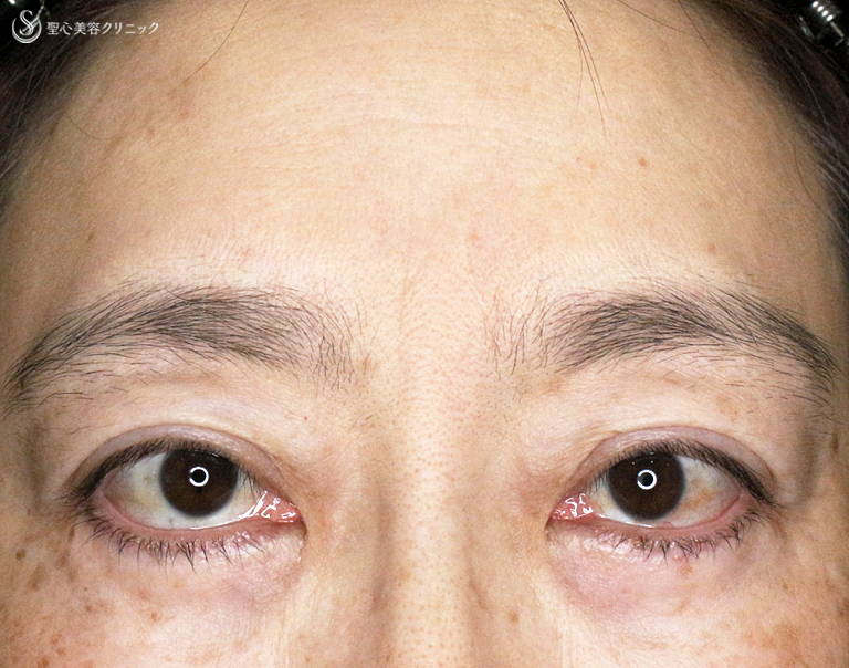 【40代女性・コンタタクトレンズ眼瞼下垂】切らない眼瞼下垂+α法（6年6ヶ月後） After 