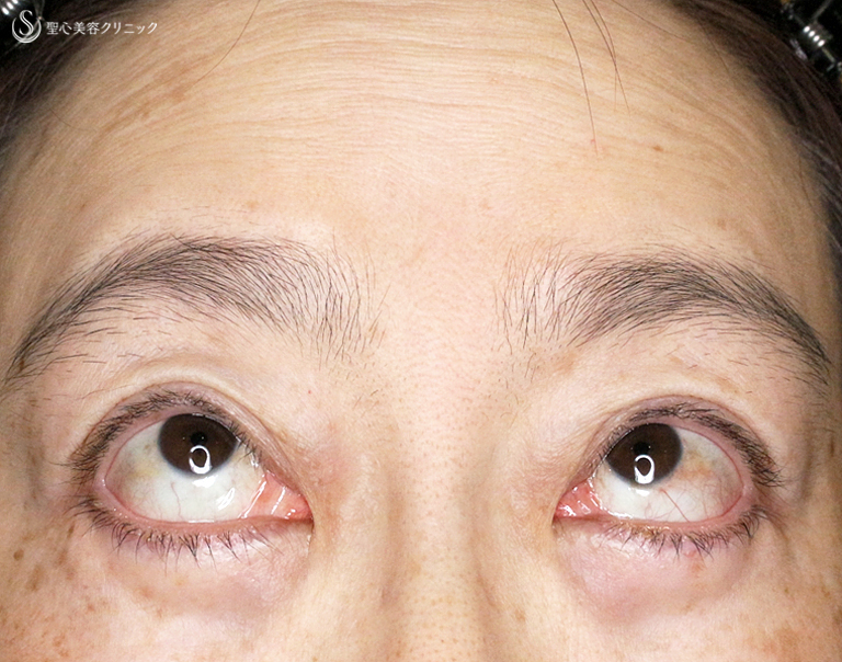 【40代女性・コンタタクトレンズ眼瞼下垂】切らない眼瞼下垂+α法（6年6ヶ月後） After 