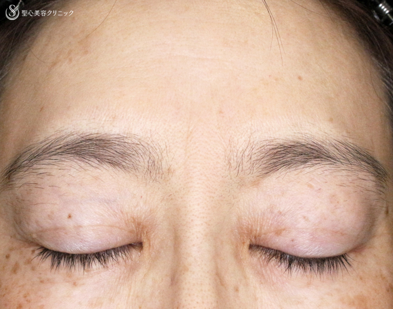 【40代女性・コンタタクトレンズ眼瞼下垂】切らない眼瞼下垂+α法（6年6ヶ月後） After 