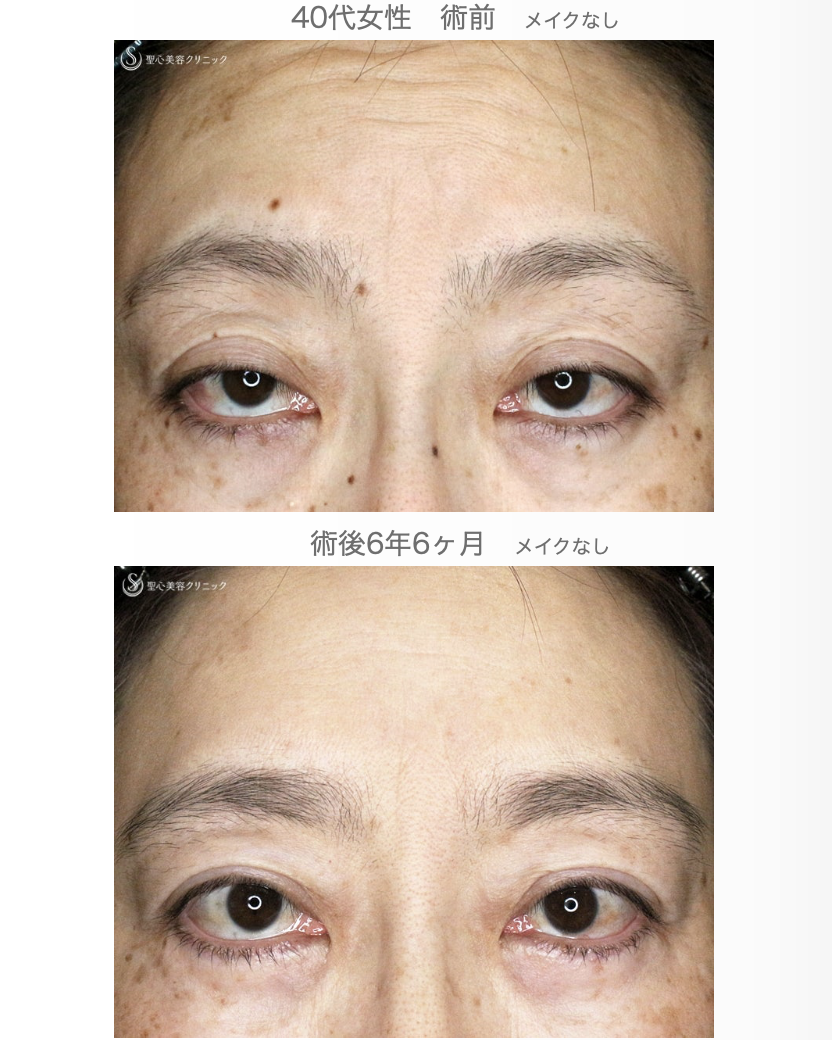 【40代女性・コンタタクトレンズ眼瞼下垂】切らない眼瞼下垂+α法（6年6ヶ月後） After 