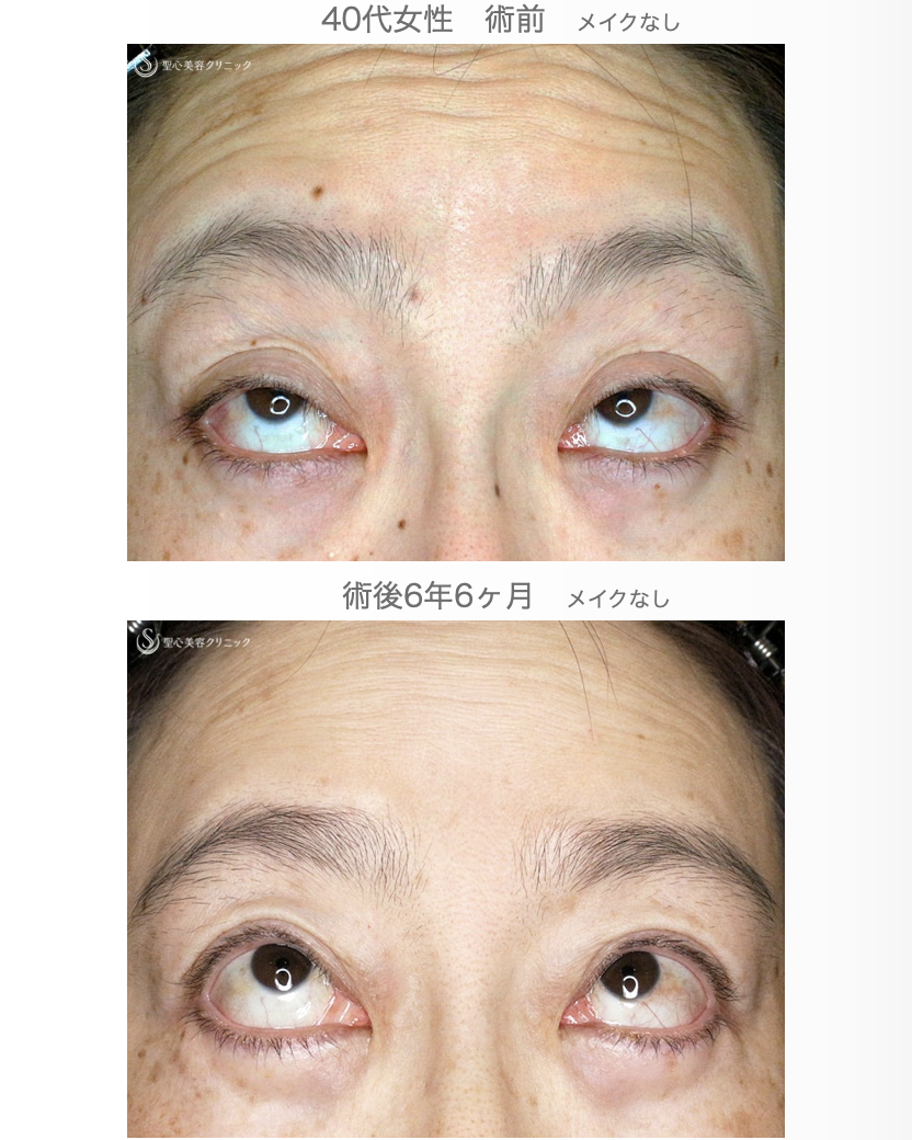 【40代女性・コンタタクトレンズ眼瞼下垂】切らない眼瞼下垂+α法（6年6ヶ月後） After 