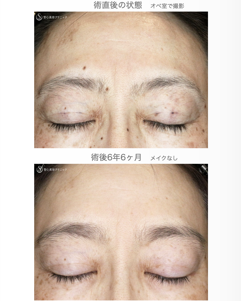 【40代女性・コンタタクトレンズ眼瞼下垂】切らない眼瞼下垂+α法（6年6ヶ月後） After 
