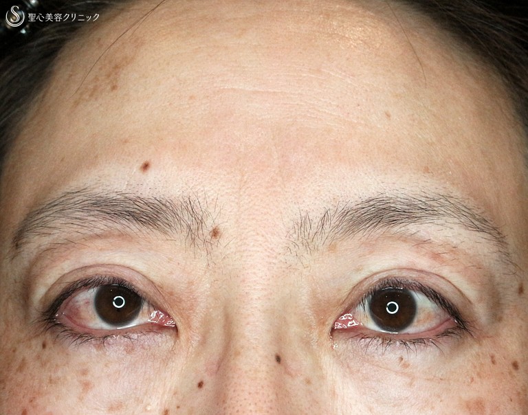 【40代女性・コンタタクトレンズ眼瞼下垂】切らない眼瞼下垂+α法（6年6ヶ月後） Before 