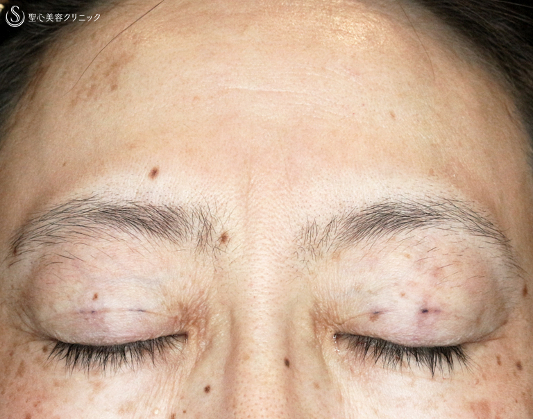 【40代女性・コンタタクトレンズ眼瞼下垂】切らない眼瞼下垂+α法（6年6ヶ月後） Before 