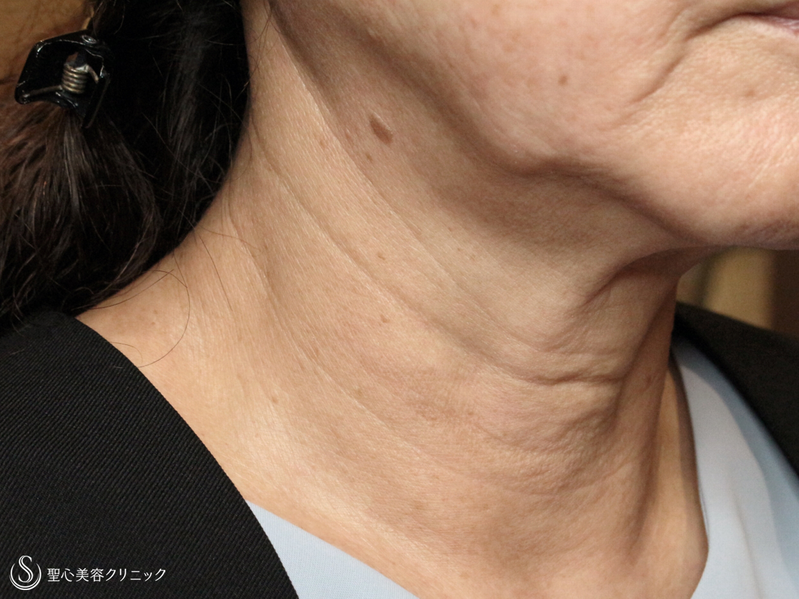 【60代女性・加齢タルミによる首の横じわ】プレミアムPRP皮膚再生療法（9ヶ月後） Before 