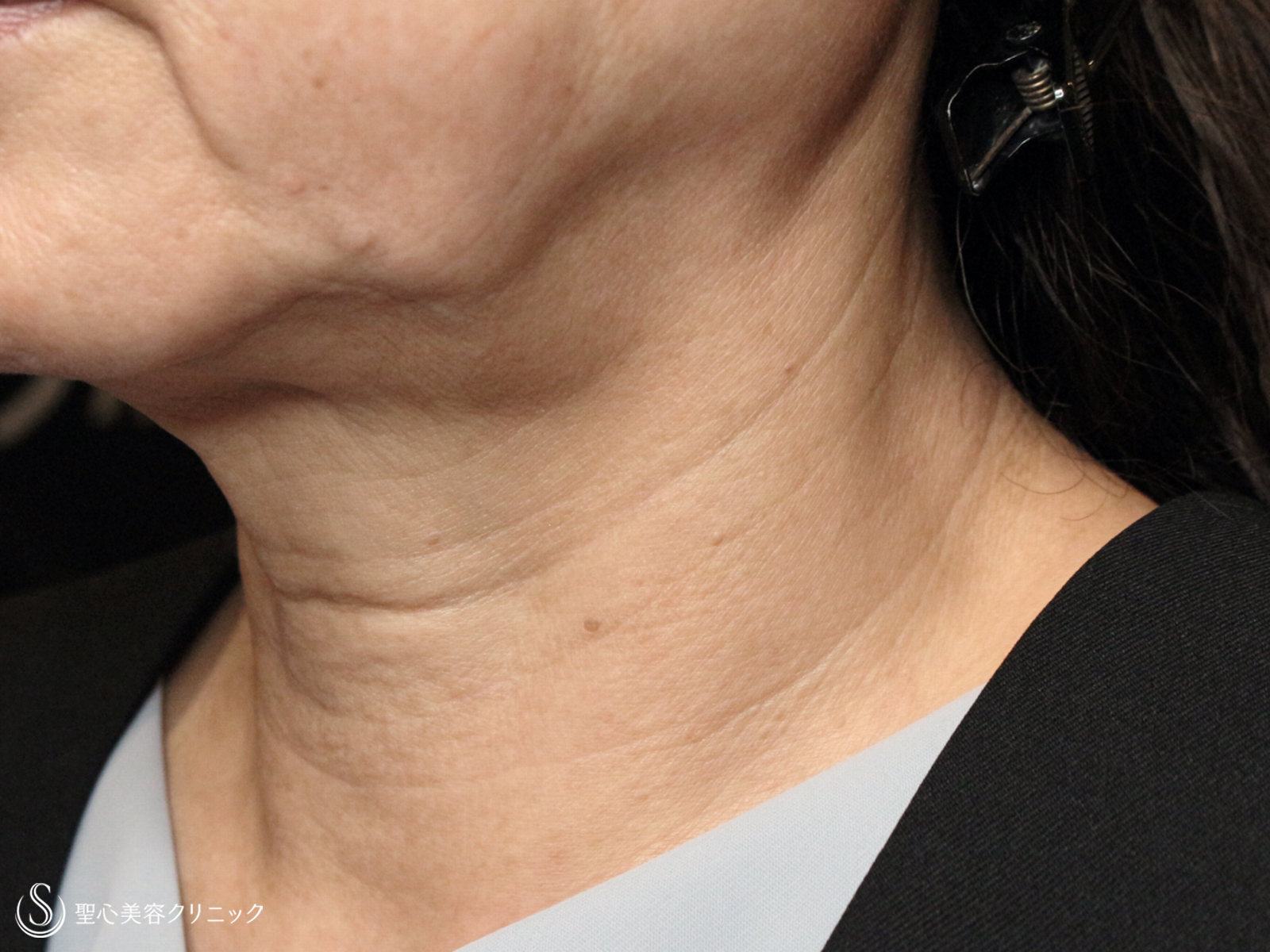 【60代女性・加齢タルミによる首の横じわ】プレミアムPRP皮膚再生療法（9ヶ月後） Before 