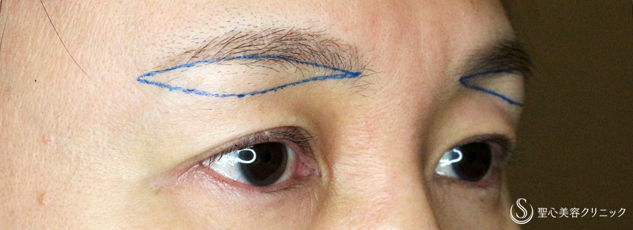 【40代女性・整形ではなく10年前の目元に戻す】眉下リフト+α単独（1年後） Before 