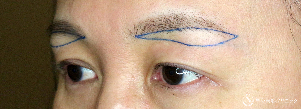 【40代女性・整形ではなく10年前の目元に戻す】眉下リフト+α単独（1年後） Before 