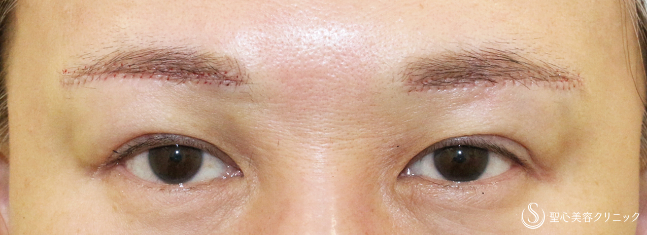 【40代女性・整形ではなく10年前の目元に戻す】眉下リフト+α単独（1年後） Before 