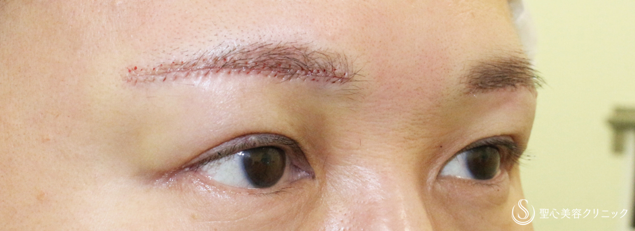 【40代女性・整形ではなく10年前の目元に戻す】眉下リフト+α単独（1年後） Before 