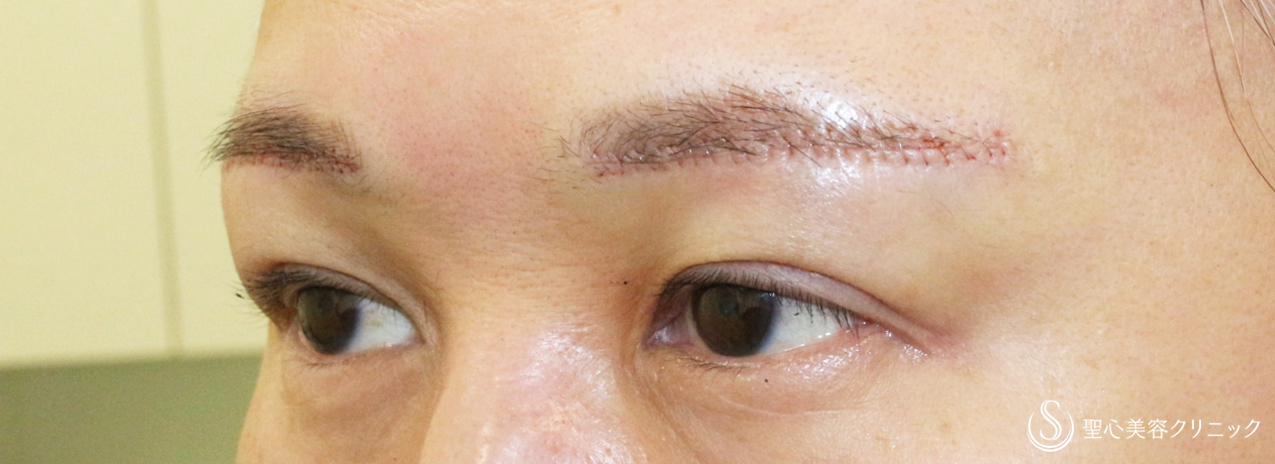 【40代女性・整形ではなく10年前の目元に戻す】眉下リフト+α単独（1年後） Before 