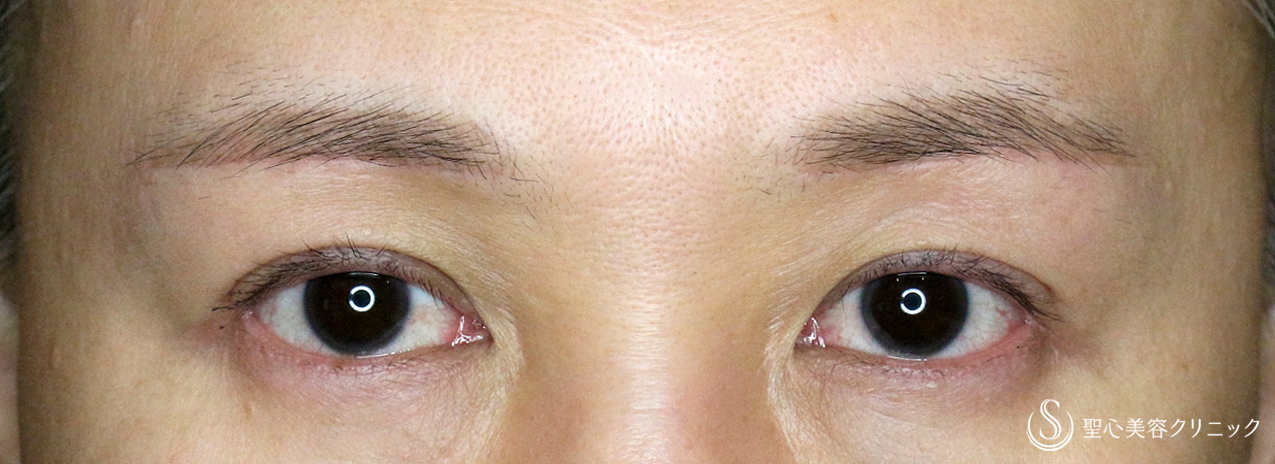 【40代女性・整形ではなく10年前の目元に戻す】眉下リフト+α単独（1年後） After 