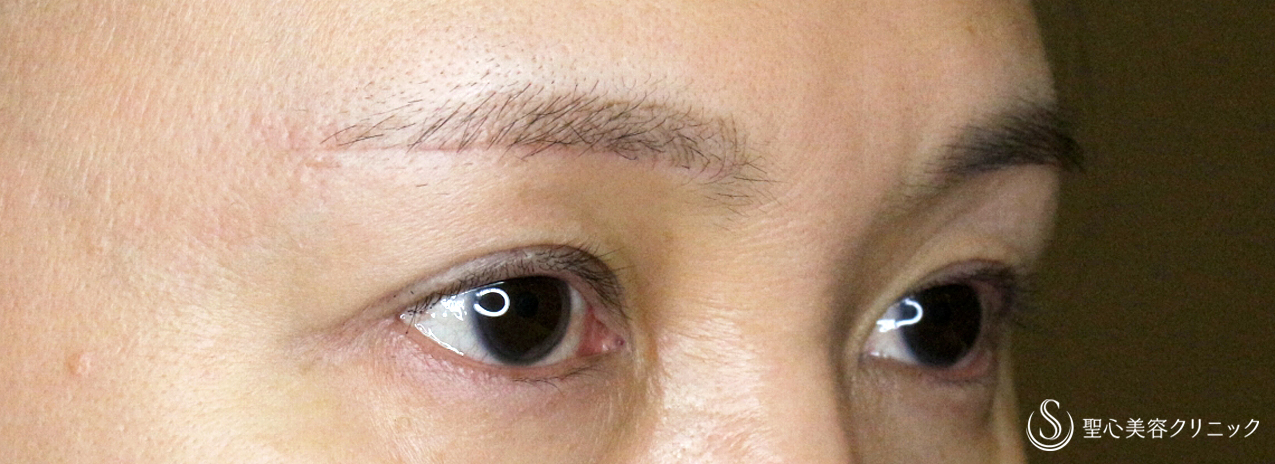 【40代女性・整形ではなく10年前の目元に戻す】眉下リフト+α単独（1年後） After 