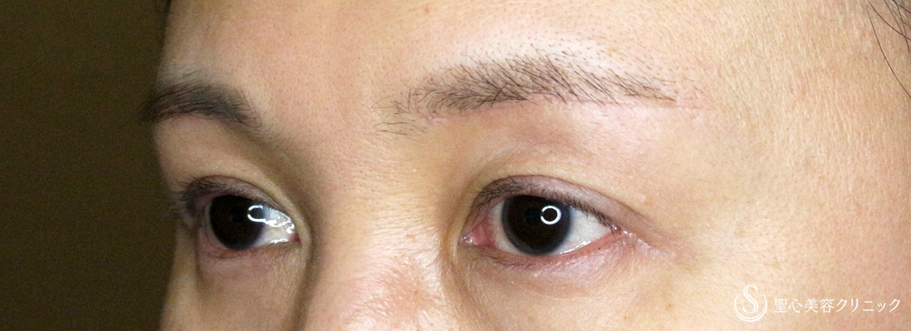 【40代女性・整形ではなく10年前の目元に戻す】眉下リフト+α単独（1年後） After 