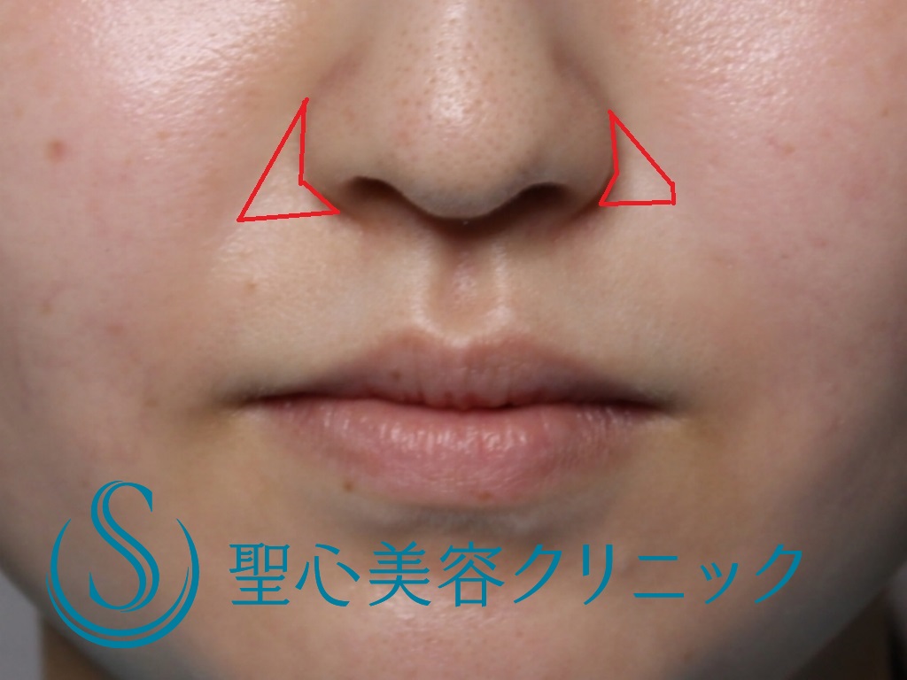 【20代女性・鼻横の凹みを目立たなく】貴族注射（プレミアムPRP皮膚再生療法）（３か月後） Before 