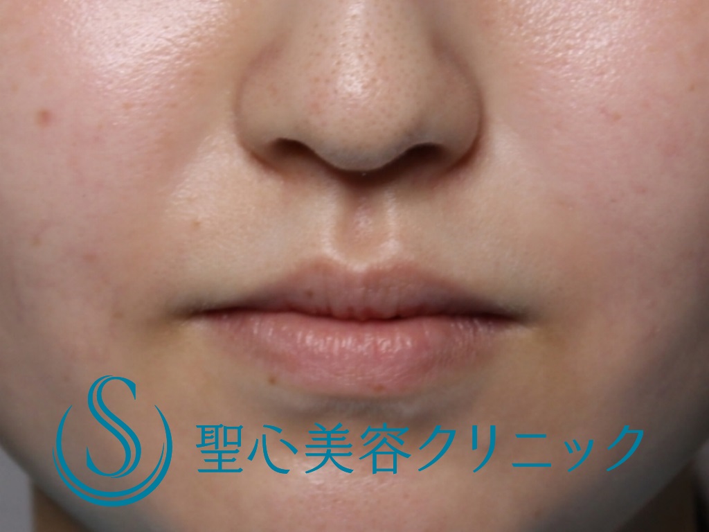 【20代女性・鼻横の凹みを目立たなく】貴族注射（プレミアムPRP皮膚再生療法）（３か月後） Before 