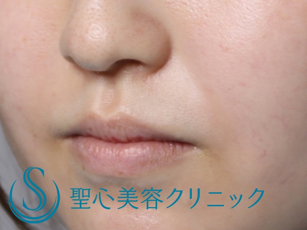 【20代女性・鼻横の凹みを目立たなく】貴族注射（プレミアムPRP皮膚再生療法）（３か月後） Before 