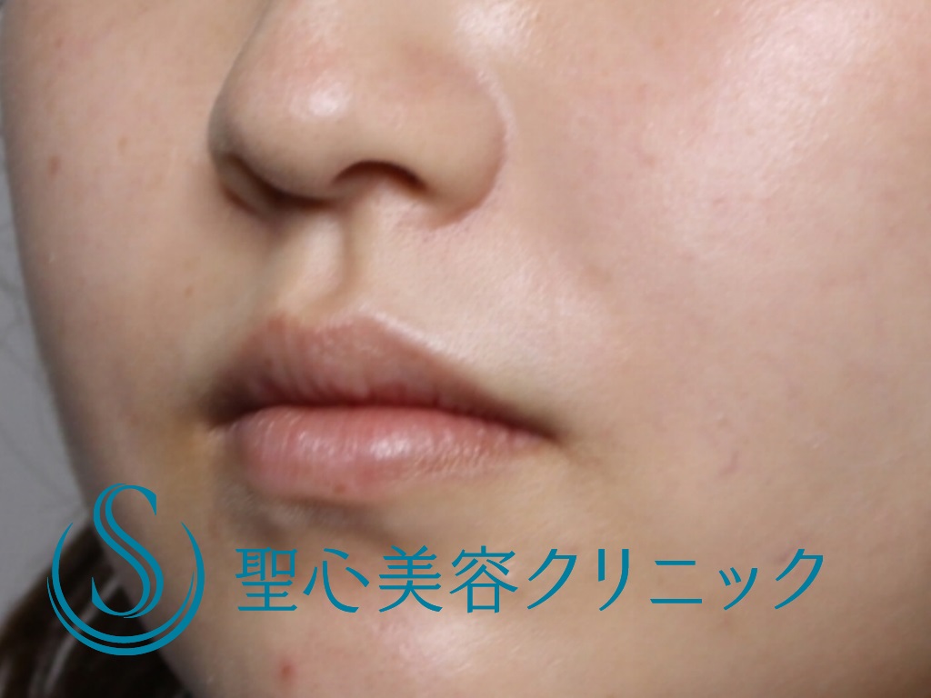 【20代女性・鼻横の凹みを目立たなく】貴族注射（プレミアムPRP皮膚再生療法）（３か月後） After 