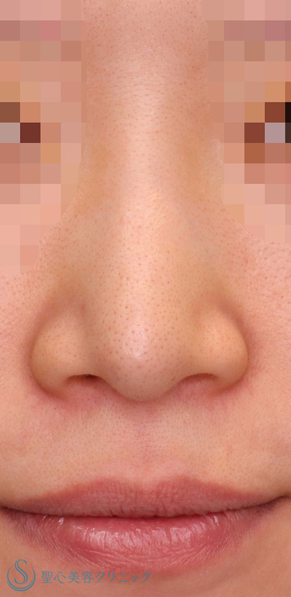 【30代女性・整形感が出ないように小鼻を小さくしたい！！笑った時に小鼻が広がらないようにしたい！！】小鼻縮小術＋側頭筋膜移植（術後1ヶ月） Before 
