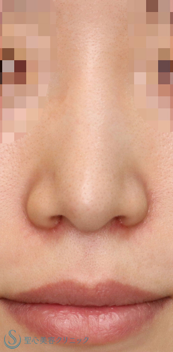 【30代女性・整形感が出ないように小鼻を小さくしたい！！笑った時に小鼻が広がらないようにしたい！！】小鼻縮小術＋側頭筋膜移植（術後1ヶ月） After 