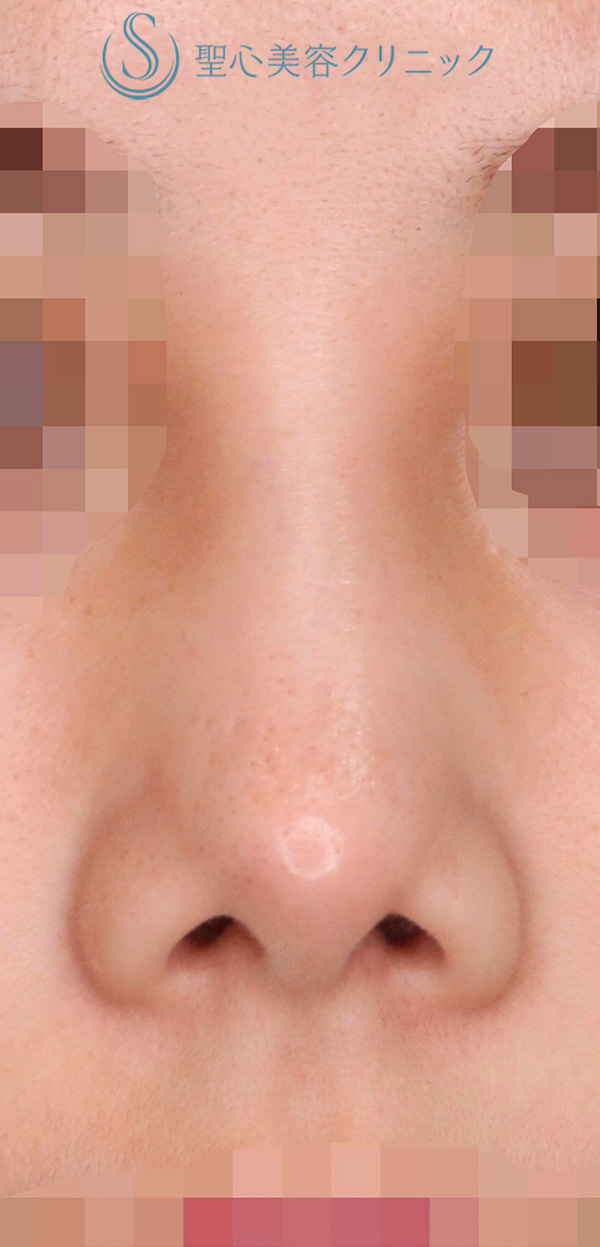 【20代女性・鼻の穴を目立ちにくくしたい！！】鼻孔縁下降術（術後9ヶ月） Before 