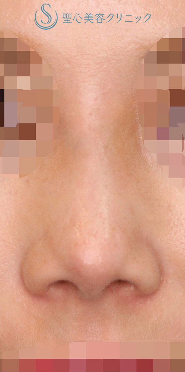 【20代女性・鼻の穴を目立ちにくくしたい！！】鼻孔縁下降術（術後9ヶ月） After 