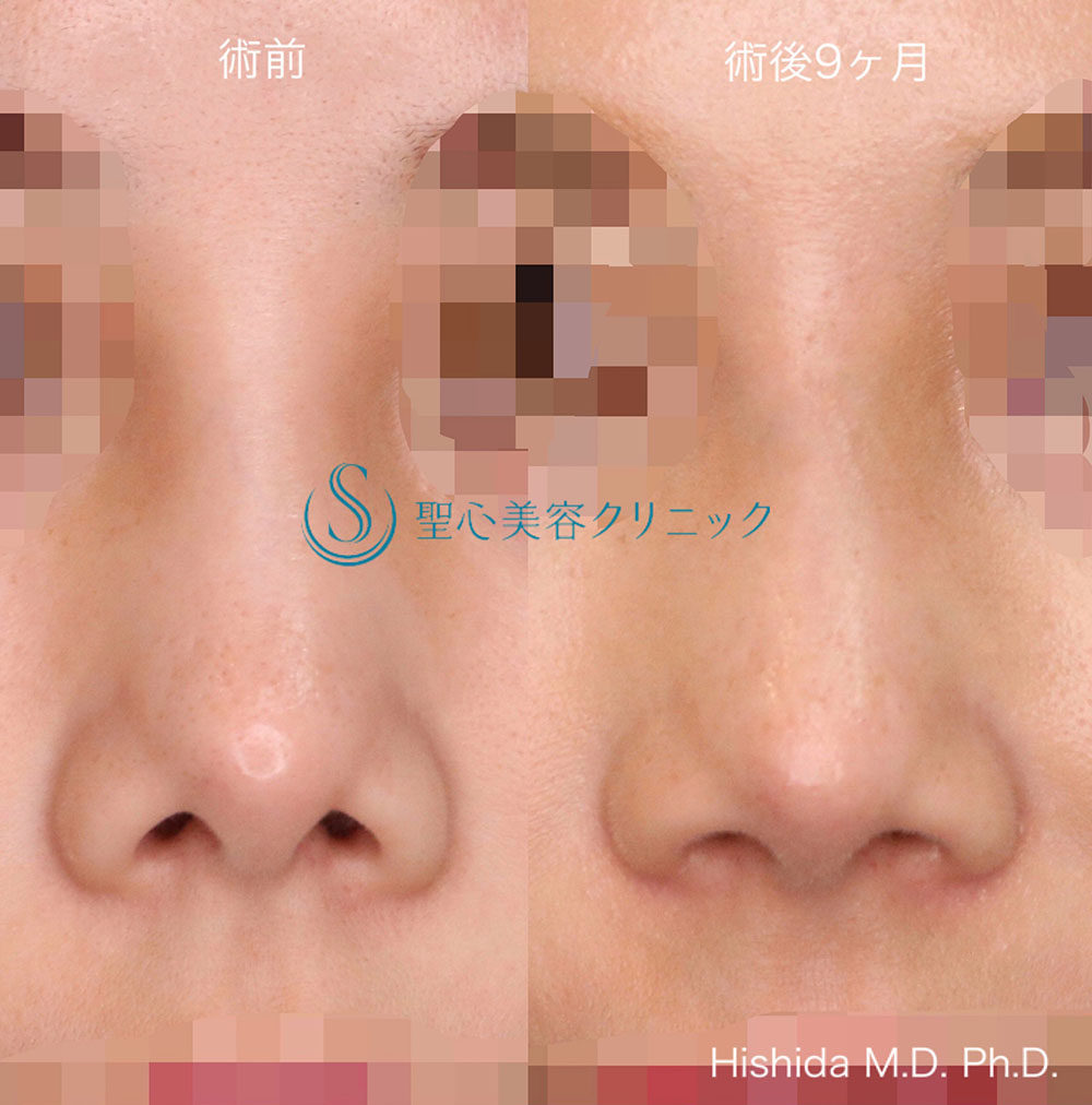 【20代女性・鼻の穴を目立ちにくくしたい！！】鼻孔縁下降術（術後9ヶ月） After 