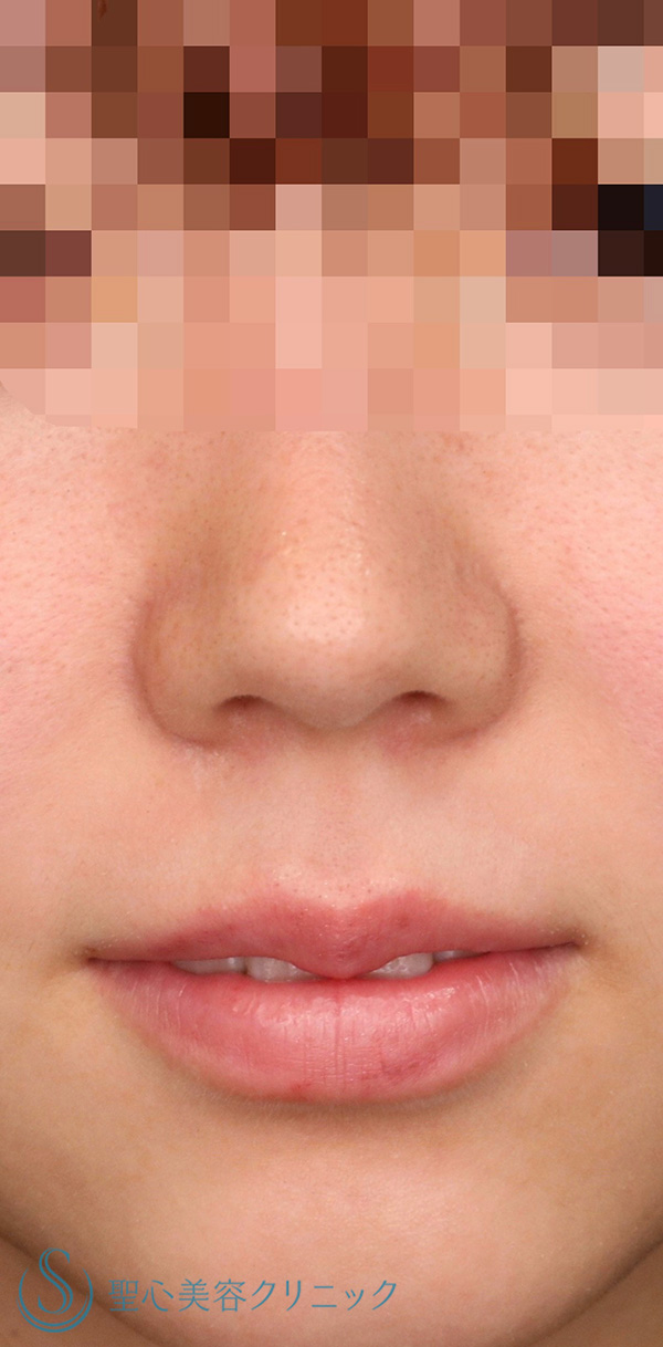 【20代女性・人中をできるだけ短くしたい！！】リップリフト（人中短縮術）（術後1ヶ月） Before 