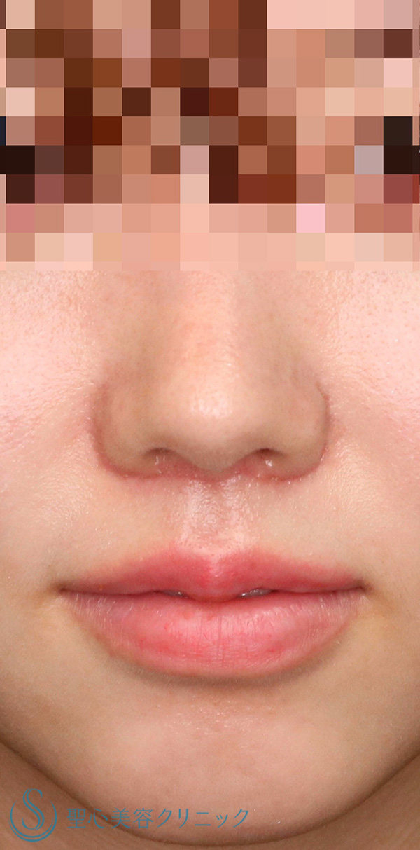【20代女性・人中をできるだけ短くしたい！！】リップリフト（人中短縮術）（術後1ヶ月） After 