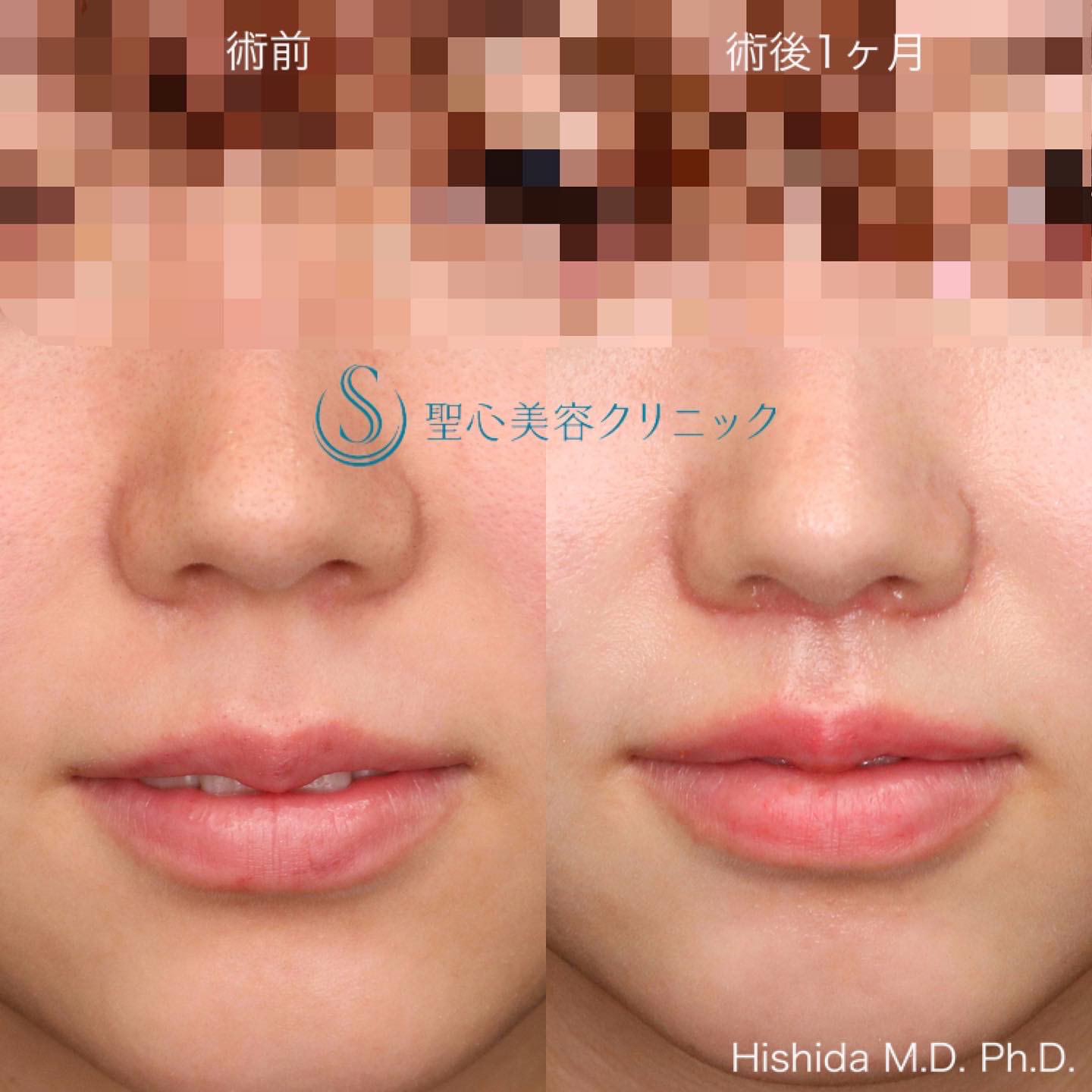 【20代女性・人中をできるだけ短くしたい！！】リップリフト（人中短縮術）（術後1ヶ月） After 
