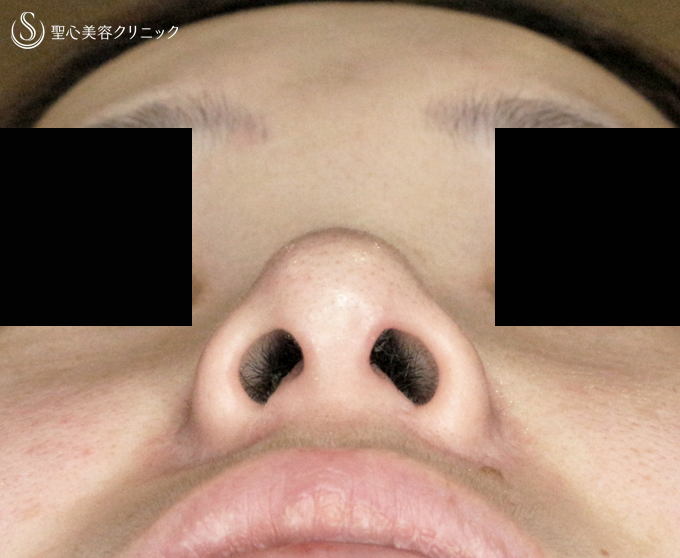 【30代女性・傷周囲の赤みが強いケース】小鼻縮小術+α法「Ver.4」（2年3ヶ月後） After 