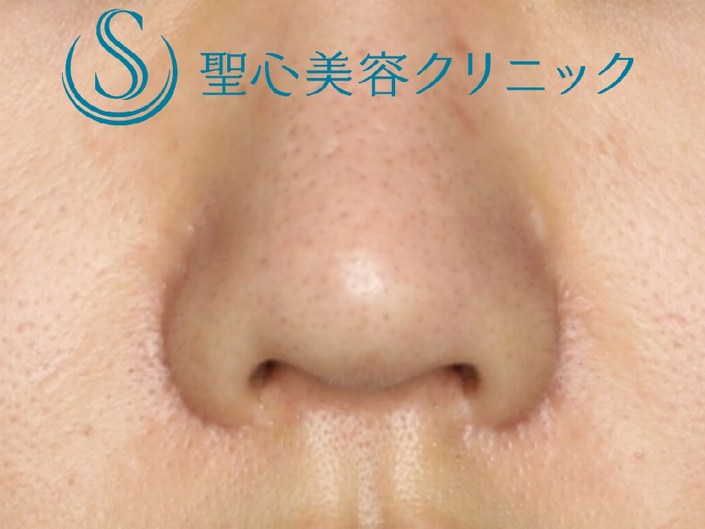 【20代女性・バランスのいい鼻へ】鼻尖縮小＋鼻尖形成+鼻柱下降術（１か月後） Before 