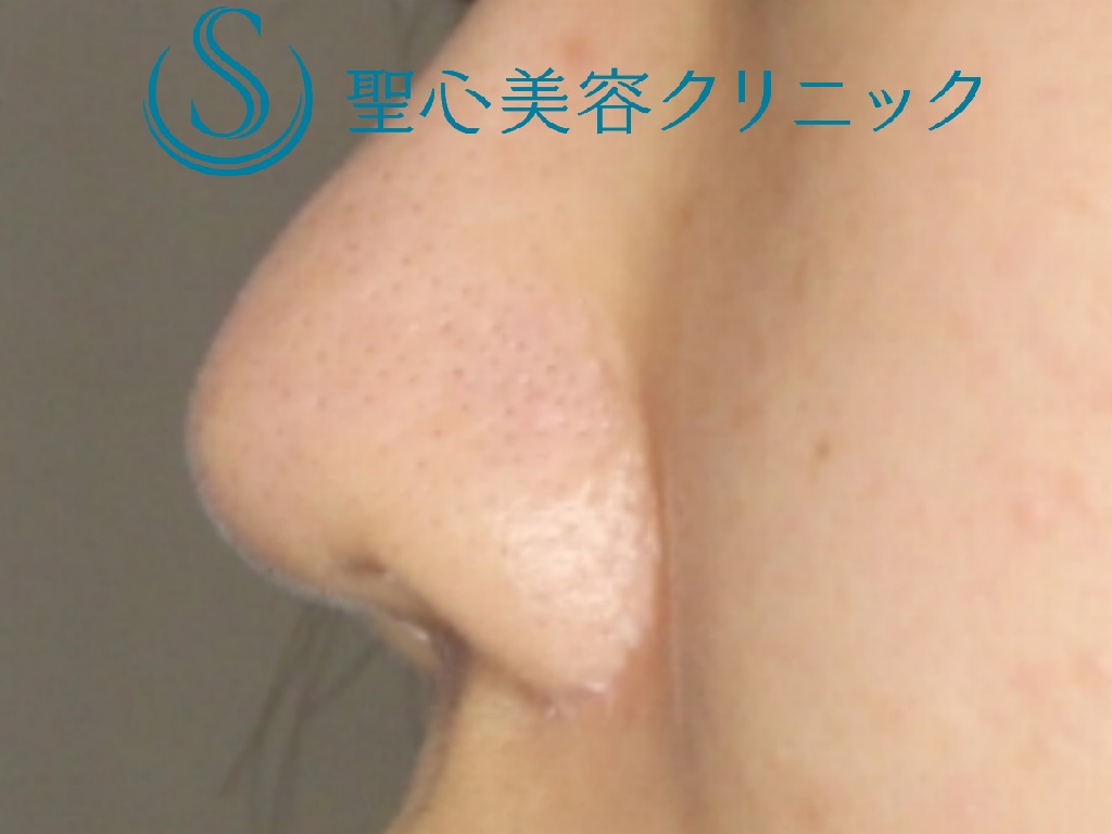 【20代女性・バランスのいい鼻へ】鼻尖縮小＋鼻尖形成+鼻柱下降術（１か月後） Before 