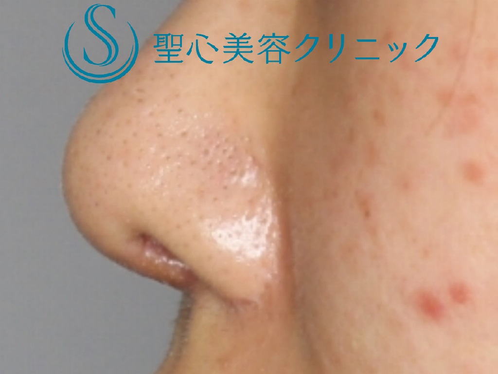 【20代女性・バランスのいい鼻へ】鼻尖縮小＋鼻尖形成+鼻柱下降術（１か月後） After 