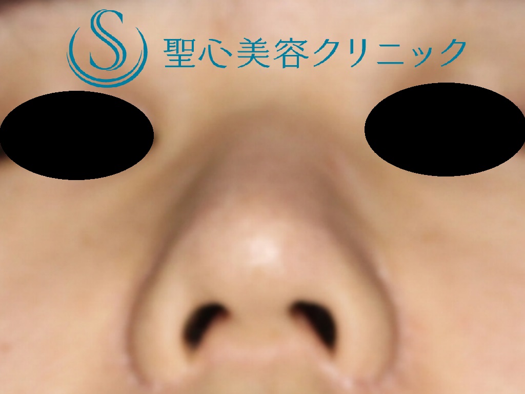 【20代女性・バランスのいい鼻へ】鼻尖縮小＋鼻尖形成+鼻柱下降術（１か月後） Before 