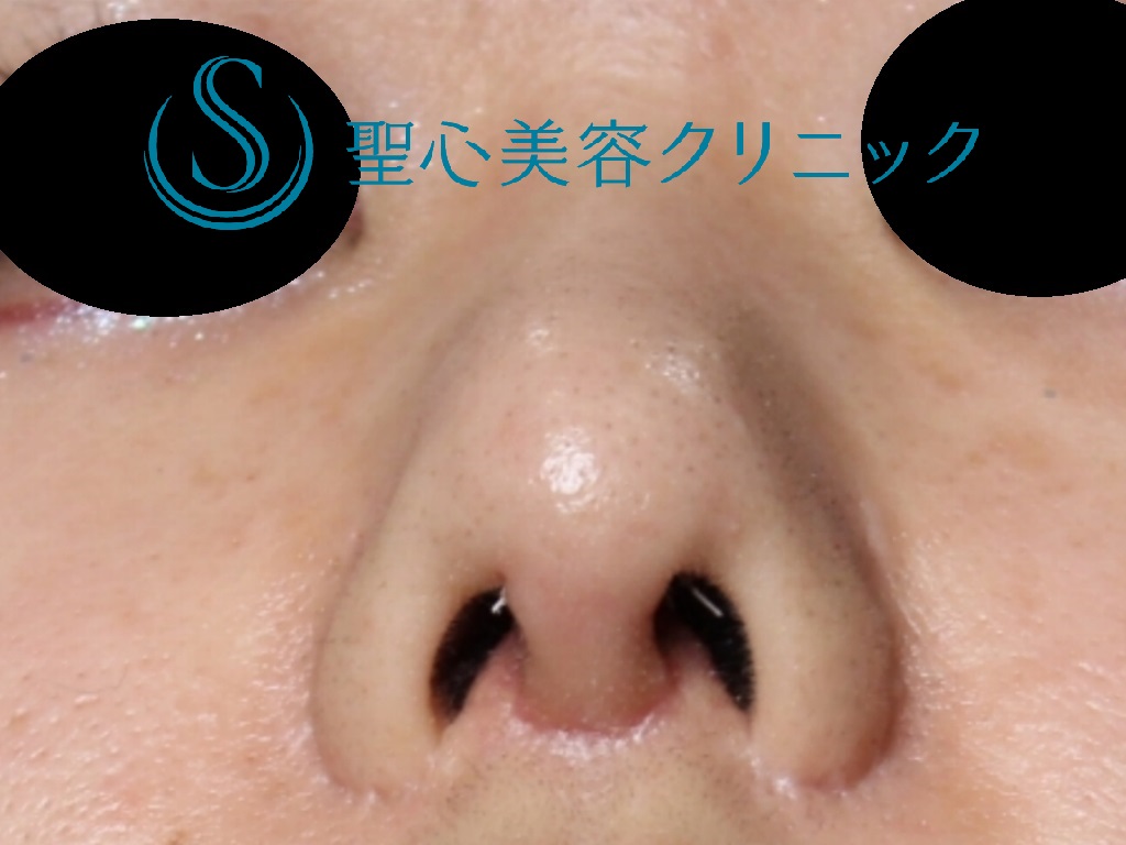 【20代女性・バランスのいい鼻へ】鼻尖縮小＋鼻尖形成+鼻柱下降術（１か月後） After 