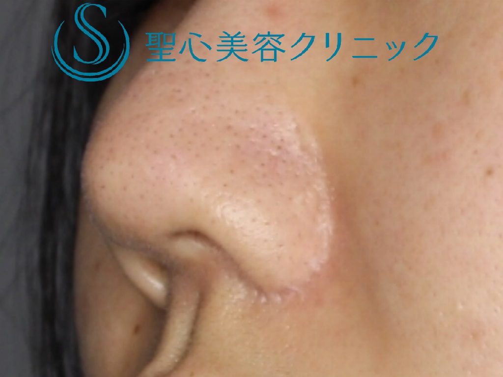 【20代女性・バランスのいい鼻へ】鼻尖縮小＋鼻尖形成+鼻柱下降術（１か月後） Before 