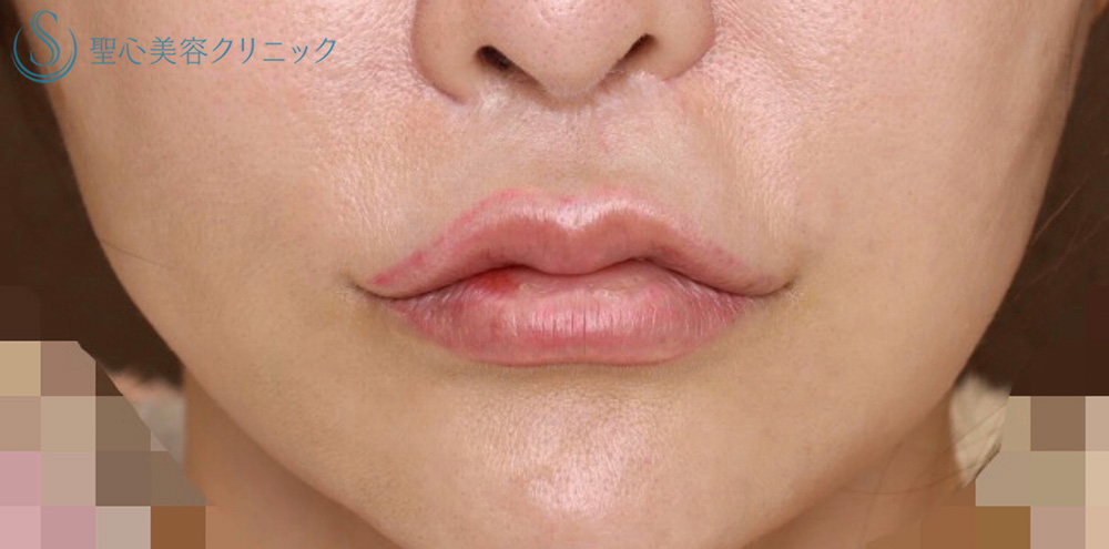 【40代女性・口元を可愛らしく】リップリフト（人中短縮術）＋プレミアム口角挙上術＋M字リップ（2年8ヶ月後） After 