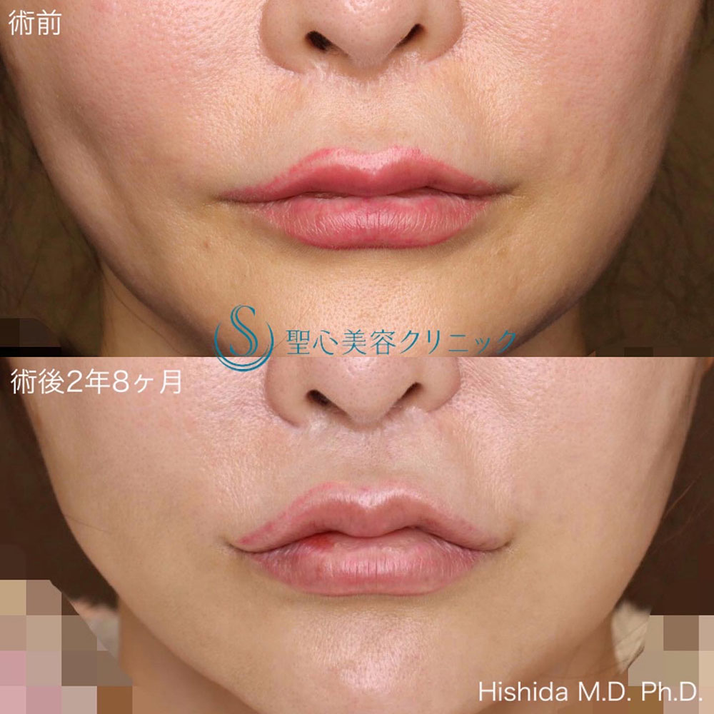 【40代女性・口元を可愛らしく】リップリフト（人中短縮術）＋プレミアム口角挙上術＋M字リップ（2年8ヶ月後） After 