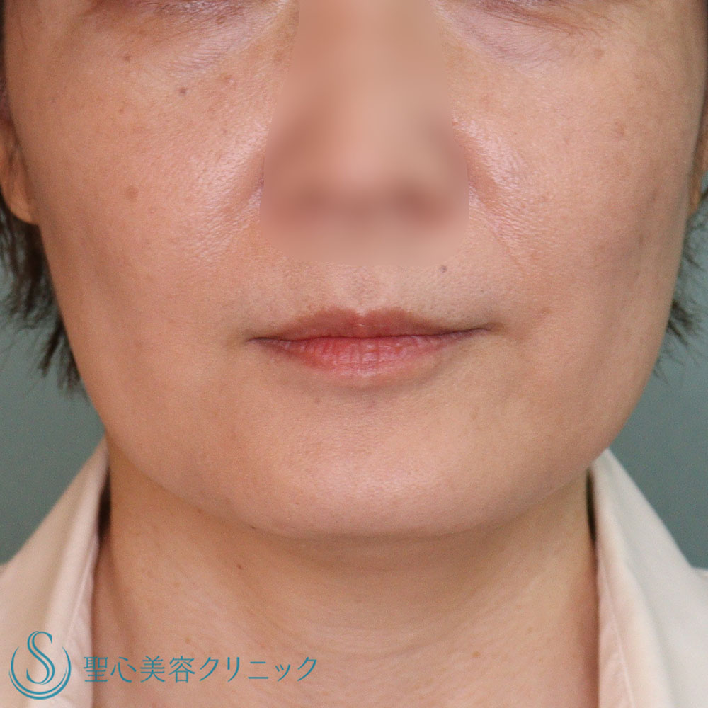 【40代女性・脂肪溶解注射】チンセラプラス頬・あご下（１か月後） Before 