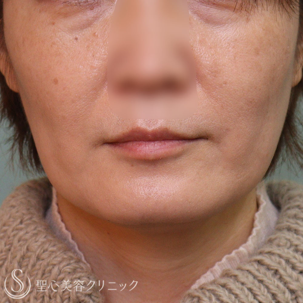 【40代女性・脂肪溶解注射】チンセラプラス頬・あご下（１か月後） After 