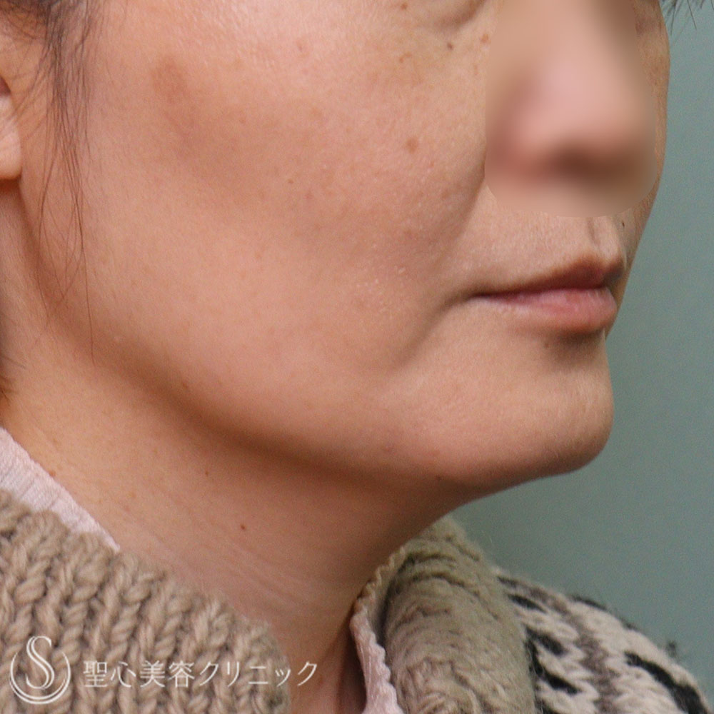 【40代女性・脂肪溶解注射】チンセラプラス頬・あご下（１か月後） After 
