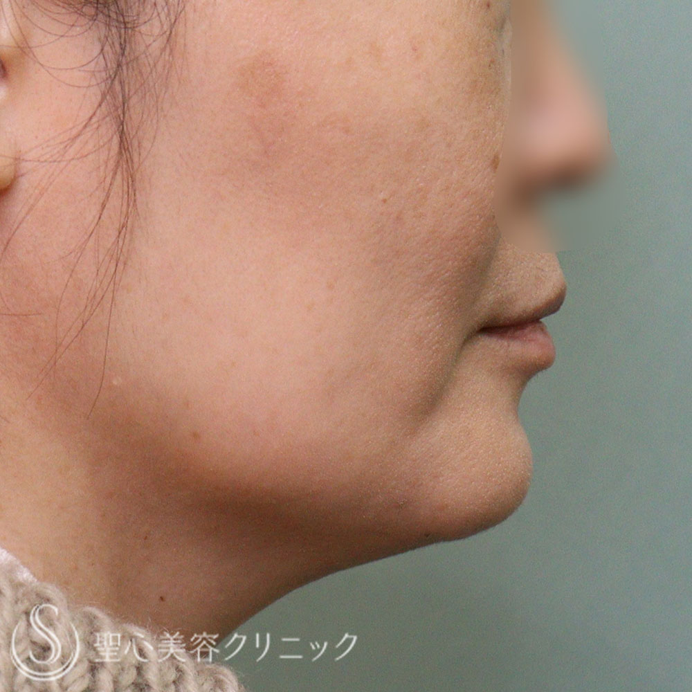 【40代女性・脂肪溶解注射】チンセラプラス頬・あご下（１か月後） After 