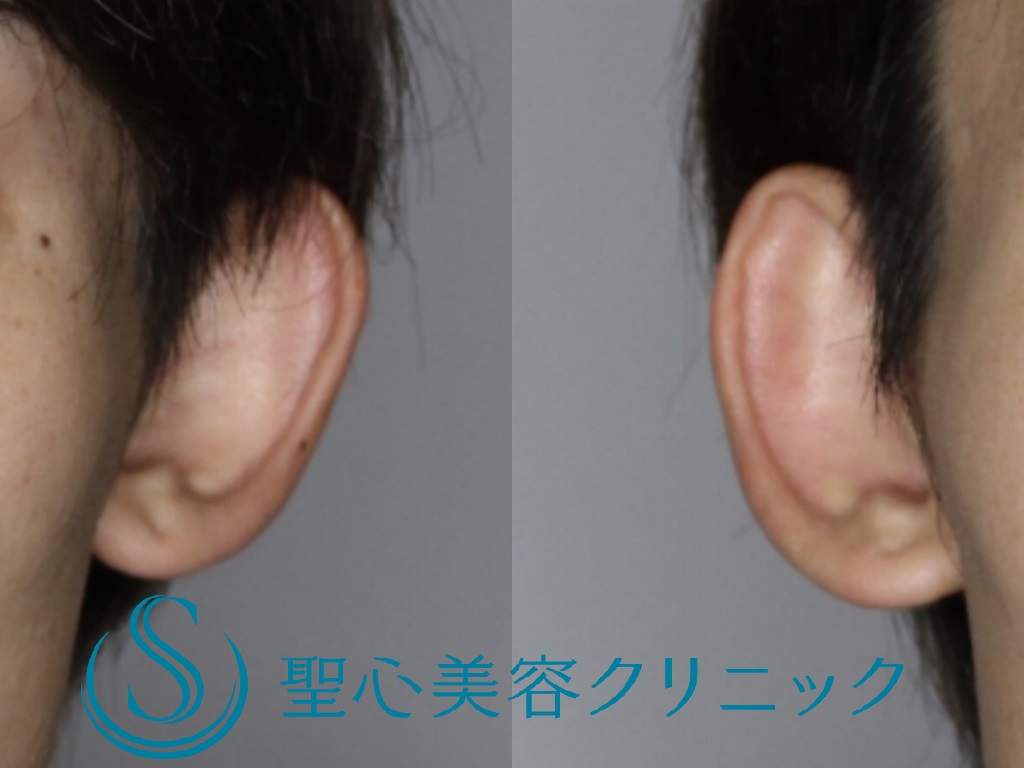 【20代男性・正面から見ても目立たない耳に】立ち耳修正（切開法）（1週間後） Before 