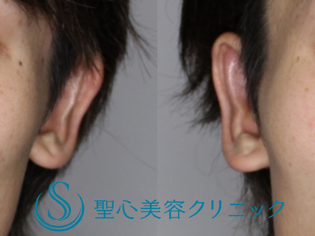【20代男性・正面から見ても目立たない耳に】立ち耳修正（切開法）（1週間後） After 