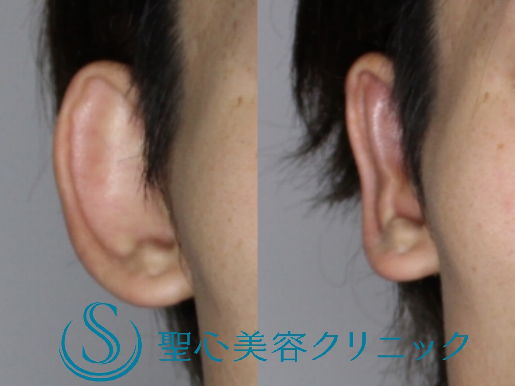 【20代男性・正面から見ても目立たない耳に】立ち耳修正（切開法）（1週間後） After 